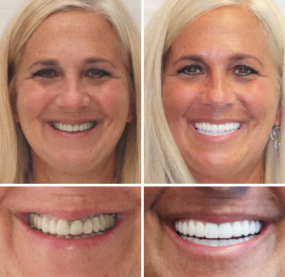 NESLEMY™ Advanced Customized Full Denture Set