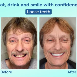 Tiworld®, Premium Denture, flexible dentures