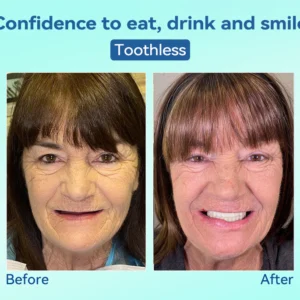 Tiworld®, Premium Denture, flexible dentures