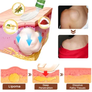 Tiworld™ LipomaCure Soothing Ointment