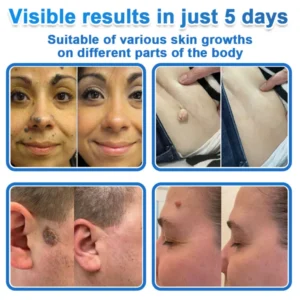 SkinPrikyn™ 2-in-1 Microneedle & Hydrocolloid Patch