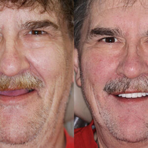 NESLEMY™ Advanced Customized Full Denture Set