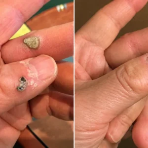 Zerowrink® 2-in-1 Microneedle & Hydrocolloid Patch