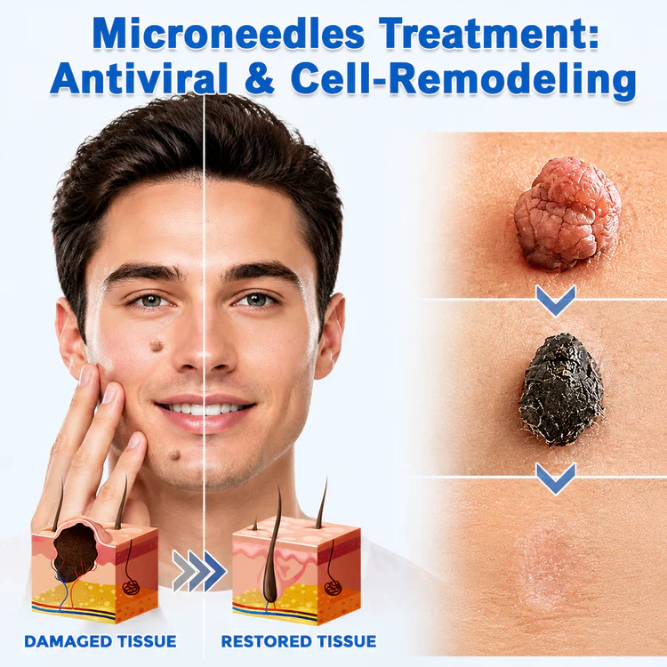 Natrvor®Patches for removing warts and moles using plant-based micro-needles