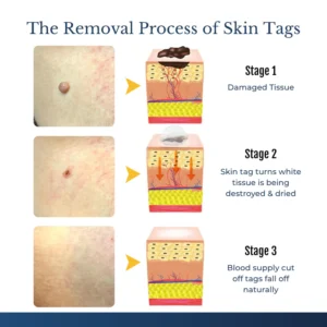 Biancat® DermFixPro 2-in-1 Microneedle & Hydrocolloid Patch