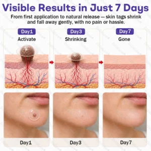 Dobshow® Wart and mole removal microneedle patch