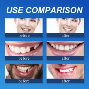 KLENIMORE™ Custom-Fit Smile Support Kit — Strong Suction Feel & Natural-Looking Fit